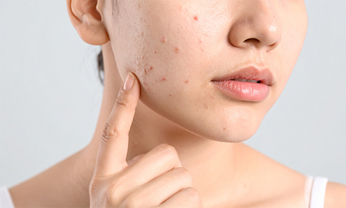 کرم و ژل ضد جوش پوست